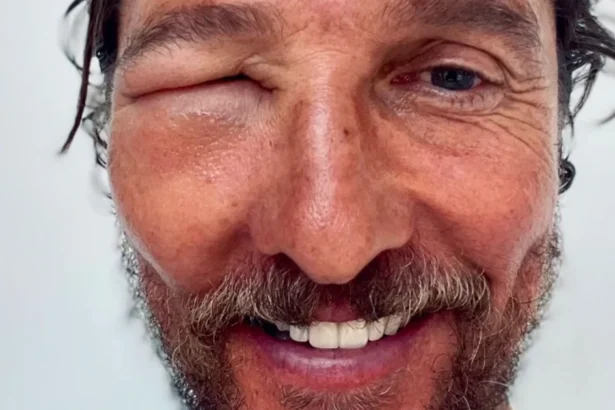 You Won't Bee-lieve What Happened to Matthew McConaughey's Eye