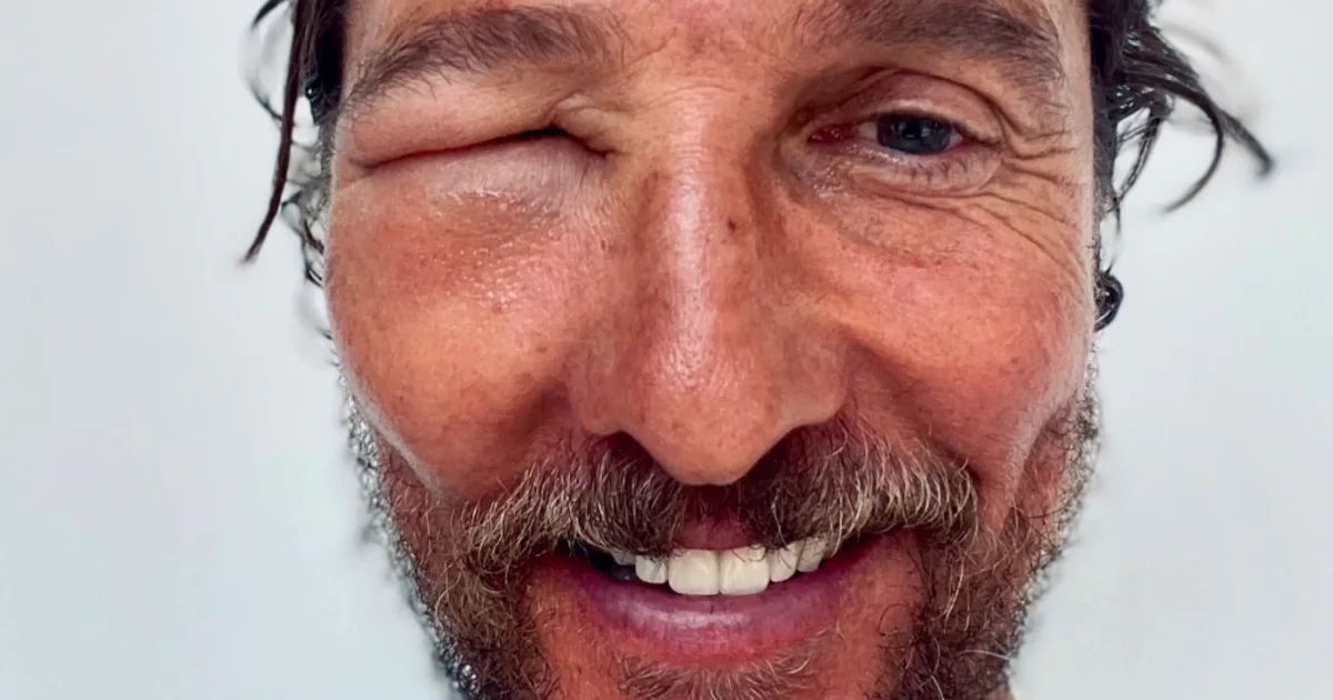 You Won't Bee-lieve What Happened to Matthew McConaughey's Eye